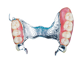 frameprothese