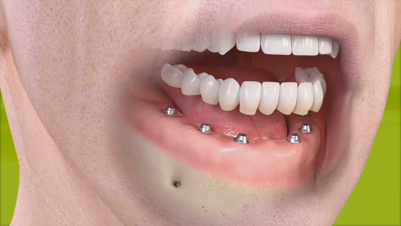 een brugwerk op implantaten